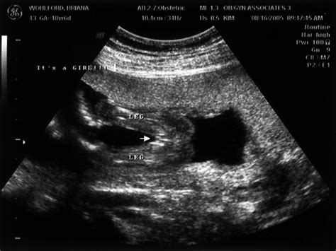 Baby Girl » Ultrasound Three