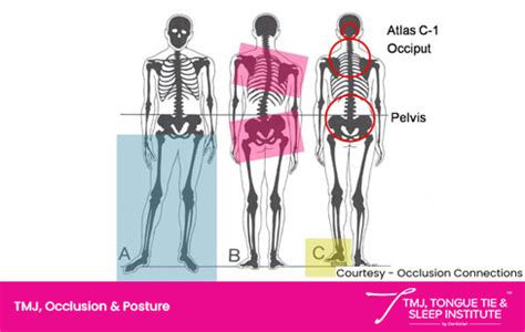 Connection Between TMJ and Body Posture - TMJ, Tongue Tie & Sleep Institute – Tongue Tie ...