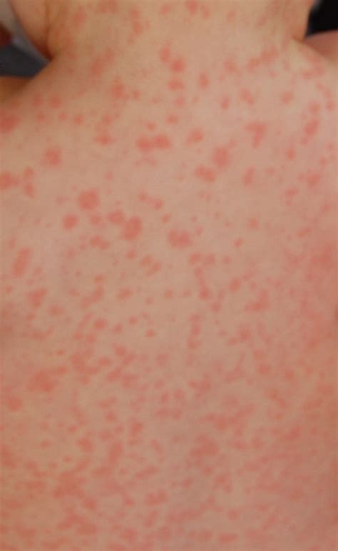 File:Amoxicillin rash 3 hours after 17th dose.JPG - Wikipedia