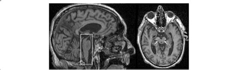 MRI of a patient with a clinical diagnosis of Progressive Supranuclear... | Download Scientific ...