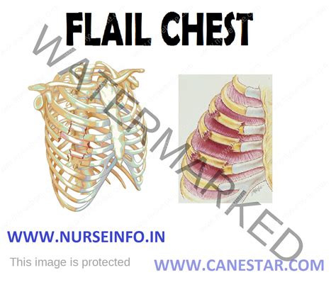 FLAIL CHEST - Nurse Info