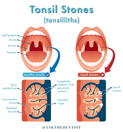 Tonsil Stones: Symptoms, Causes, and How to Remove