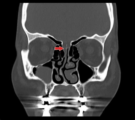 Cureus | Spontaneous Cerebro-Spinal Fluid Rhinorrhoea Caused by Sustained Intracranial Hypertension