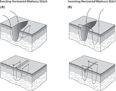 Figure 1 from The inverting horizontal mattress suture: applications in dermatologic surgery ...