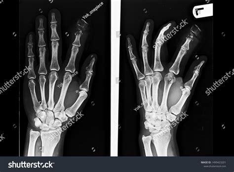 Anteroposterior Oblique View Hand Wrist Xray Stock Photo 1499423201 ...