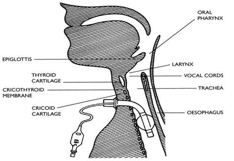 Tracheostomy Care- Indications|Types|Care