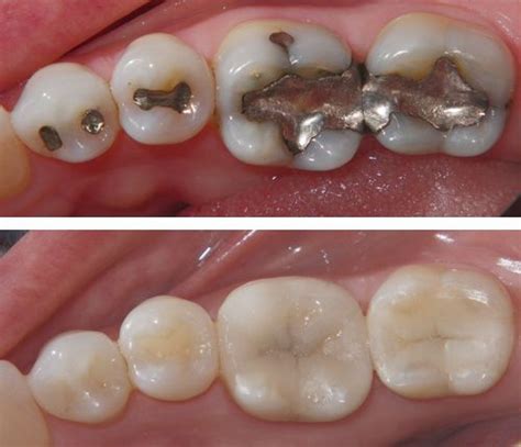 Silver Fillings versus White Teeth Fillings, Which is better? - Headgear Braces