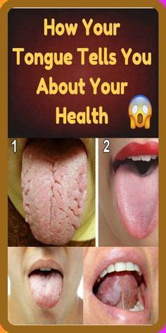 Home Remedies for Treating Sore Tongue | Tongue sores, Tongue ulcer remedies, Canker sore