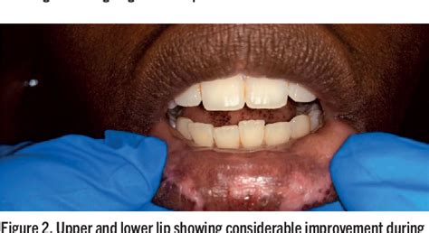 Figure 2 from A Case Report on Stomatitis Venenata Due to the Use of Lip Balm | Semantic Scholar