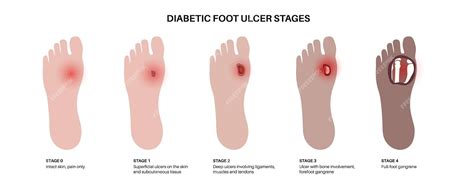 Premium Vector | Diabetic foot syndrome stages deep ulcer open sore or wound on feet ...