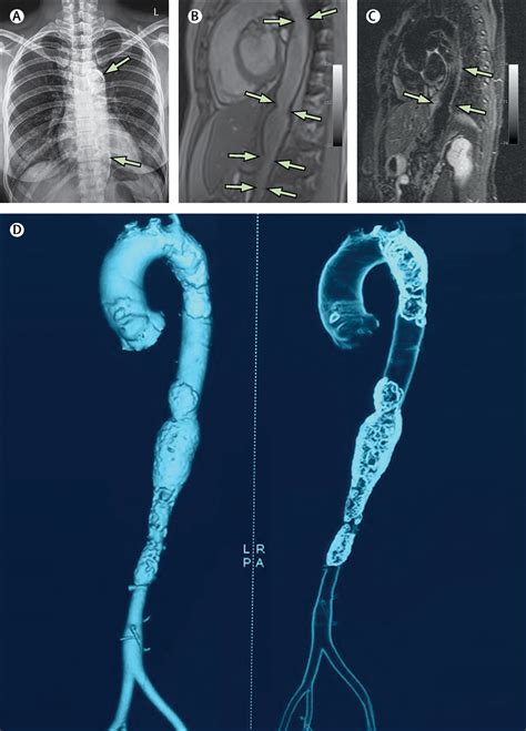 Aortic calcification in longstanding, undiagnosed Takayasu arteritis ...