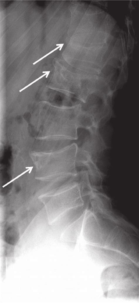 Lumbar Spine Fracture X Ray