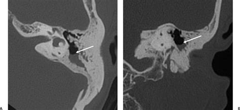 The Middle Ear and Mastoid | Radiology Key