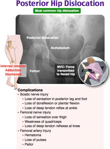 Hip Dislocations Flashcards | Quizlet