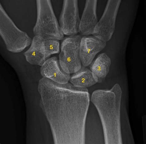 The X-ray image of carpal bones (Benoudina Samir, Radiopaedia.org, rID:... | Download Scientific ...