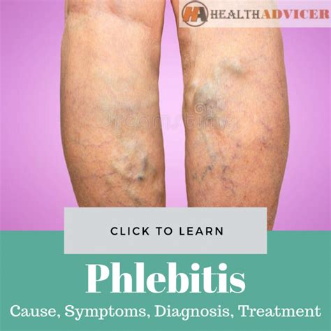 Phlebitis: Causes, Picture, Symptoms and Treatment