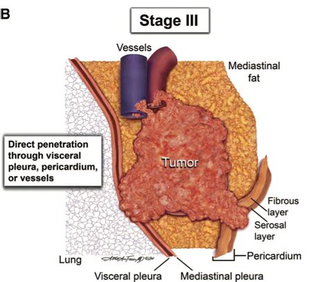 Staging – Foundation for Thymic Cancer Research