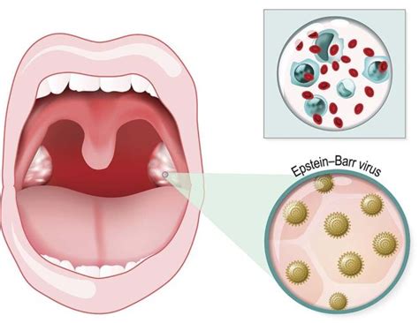 What Is Mononucleosis? Symptoms, Diagnosis, & Treatment