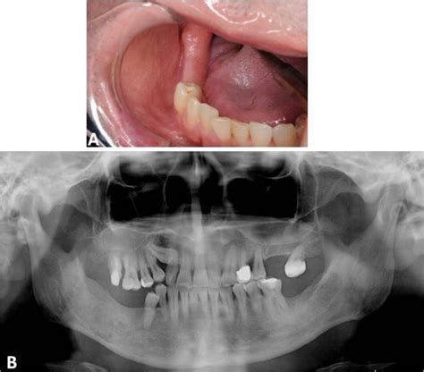 Surgical management of odontogenic myxoma: a case report and review of the literature | BMC ...