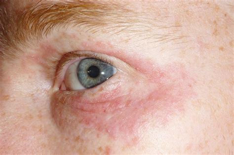 Rash Around Eyes: Learn About Symptoms and Possible causes