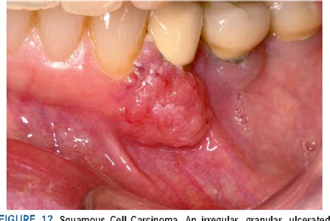 Figure 12 from Oral cavity and oropharyngeal squamous cell carcinoma--an update. | Semantic Scholar