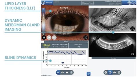 What a Dry Eye Exam Looks Like | Dr. Shaver - The Eye Center