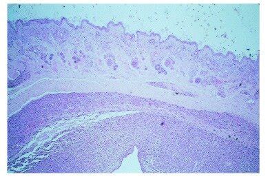 Photomicrograph, case 2. Notice the infiltrate in the skin, primarily ...