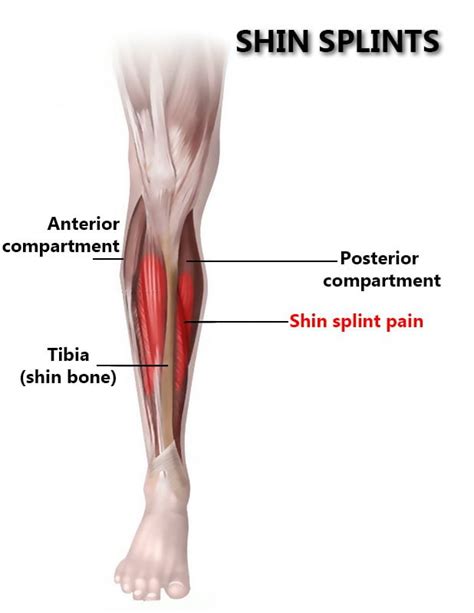 Shin Splints in NYC | New York Pain Care