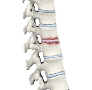 Spine Arthritis | Advanced Orthopaedics & Sports Medicine, Orthopaedic Specialists, Cypress ...