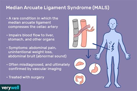 MALS (Median Arcuate Ligament Syndrome)