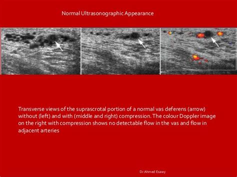 Imaging vastitis differentitis funiculitis seminal vesiculitis Dr Ahm…