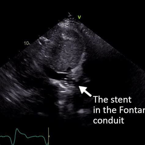 Fontan conduit angiography before stenting: a narrow (11.2 mm ...