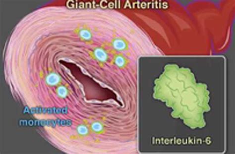 Giant Cell Arteritis