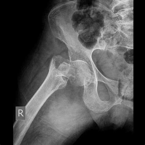 Femoral Neck Fracture