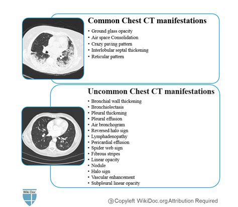 COVID-19 CT scan - wikidoc