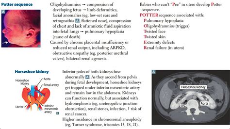 potter sequence || horseshoe kidney || what is potter sequence #usmle ...