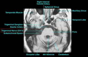 MRI Protocols: Trigeminal Neuralgia or Facial Hemispasm MRI Protocol