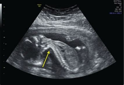 Breech Presentation - Obstetrics - Medbullets Step 2/3