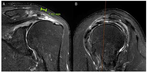 Supraspinatus Tear Mri