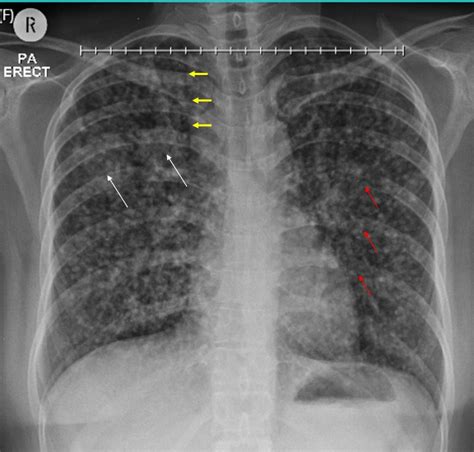 Lung adenocarcinoma – Radiology Cases