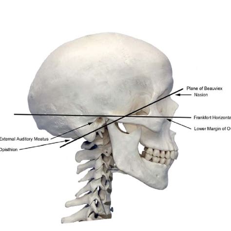 Frankfort Plane Dental Definition - DEFINITION HJO