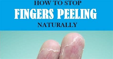 How To Stop Fingers Peeling Naturally At Home?