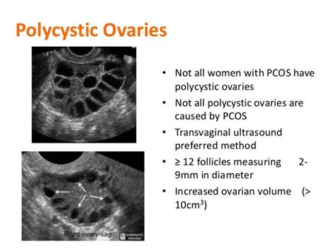 polycystic ovary syndrome ultrasound - Αναζήτηση Google | Ultrasound, Polycystic ovary syndrome ...