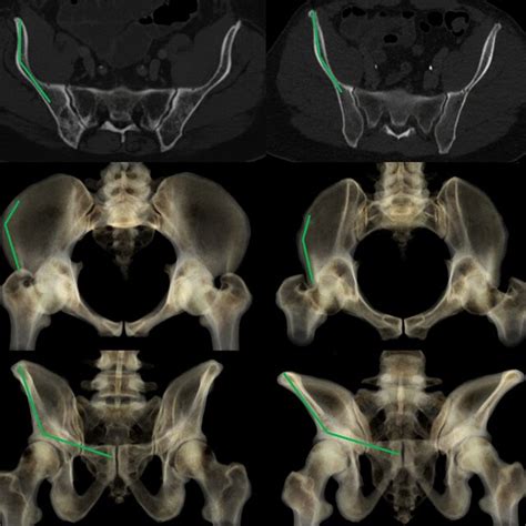 AP, inlet, outlet x-ray and axial CT cuts of a female pelvis. The axial ...