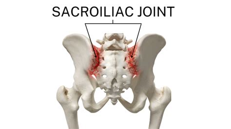 Sacroiliac Joint Pain