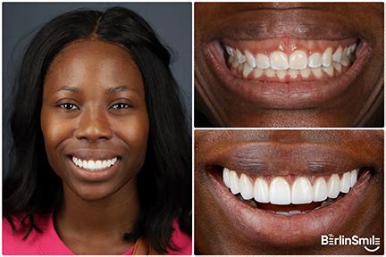 The Berlin Smile | Smile Improvement In McKinney, TX | McKinney Dental