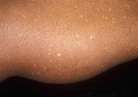 Small White Spots on Legs: Causes, Pictures & Treatment – Treat n Heal