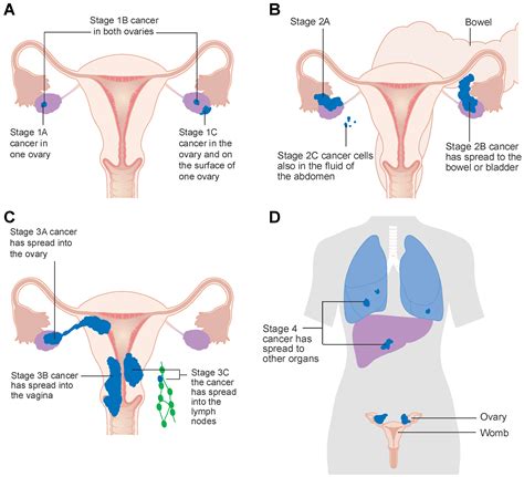 Ovarian Cancer Staging - Surgery for Ovarian Cancer: Principles and Practice - Free ...