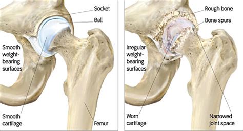 Bone-Sparing Total Hip Resurfacing Arthroplasty Surgery (Metal-on-Metal Device) | UW ...