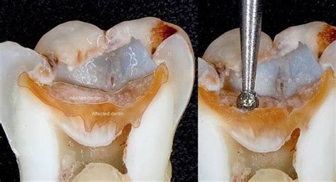 Dentaltown - Leaving infected dentin? Infected dentin is the irreversible demineralized ...